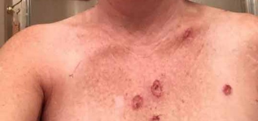 Tanning bed result: Skin cancer